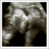 sonogram